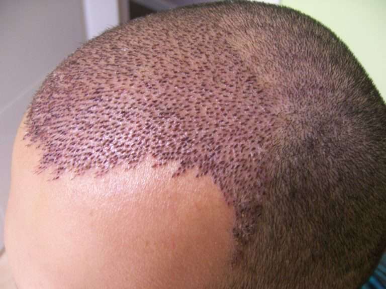 Taboola Ad Example 36038 - Hair Transplant Costs In South Africa Might Actually Surprise You