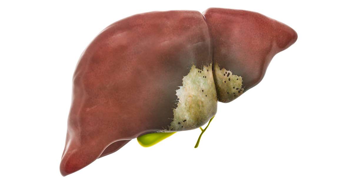 Google Ad Exchange Ad Example 38068 - 5 Herbs May ReduceFatty Liver
