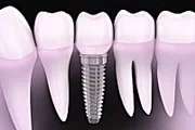 Outbrain Ad Example 40661 - Dental Implants Cost In 2019 May Surprise You
