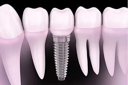 Outbrain Ad Example 41267 - Here Is What New Dental Implants Should Cost You In 2019