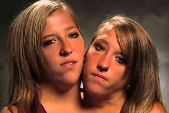 Outbrain Ad Example 44976 - [Photos] Siamese Twins Are 27 Years Old - And Make A Life-Changing Decision