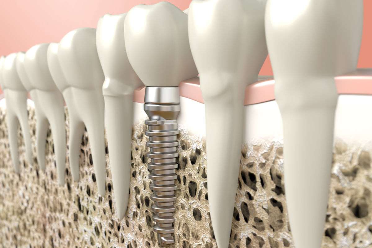 RevContent Ad Example 51011 - The Cost Of Dental Implants In Local Area Might Surprise You