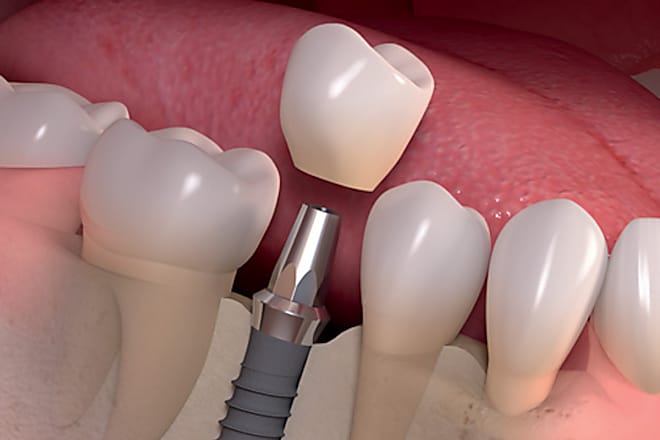 Taboola Ad Example 7779 - Dental Implants | Sponsored Links