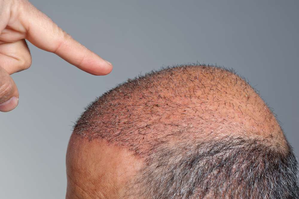 Taboola Ad Example 43211 - The Cost Of Hair Transplant In Dubai Might Surprise You