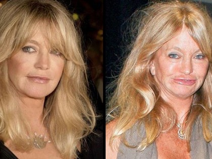 RevContent Ad Example 9436 - 35 Celebs Before And After Botched Plastic Surgery