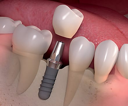 Taboola Ad Example 2867 - This Is What Dental Implants Should Cost In Clovis