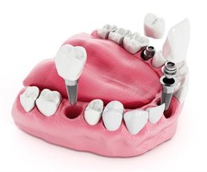 Content.Ad Ad Example 7797 - Think Dental Implants Are Expensive? Think Again (Prices)