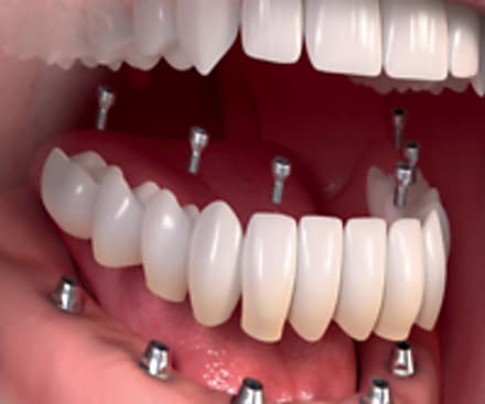 Taboola Ad Example 11708 - Dental Implants | Sponsored Links