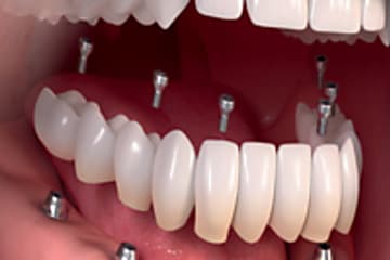 Taboola Ad Example 12799 - Dental Implants | Sponsored Links