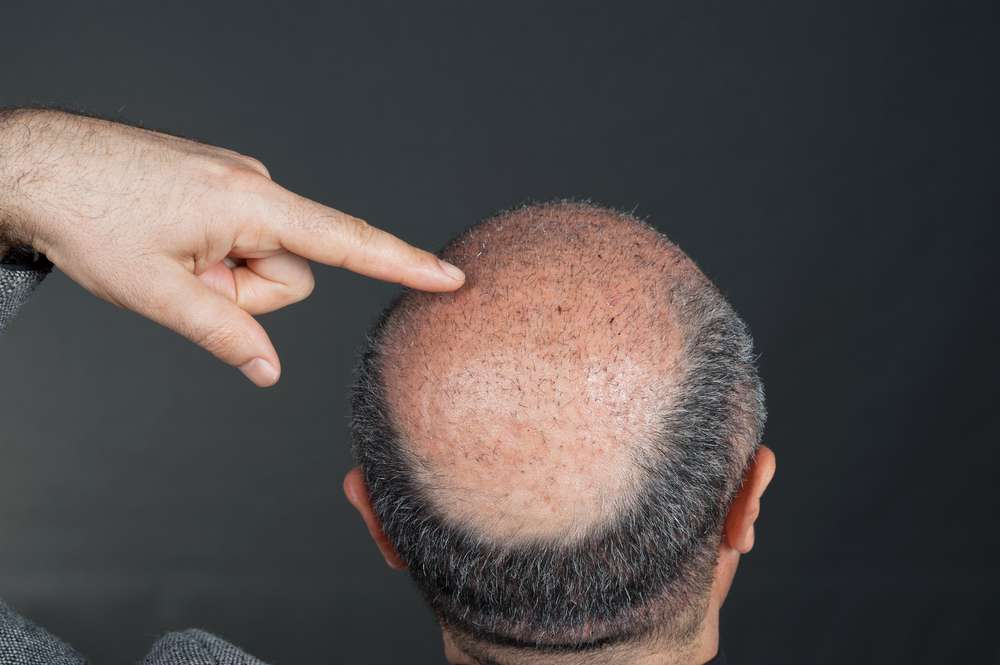 Taboola Ad Example 55843 - The Cost Of Hair Transplant In Turkey Might Surprise You