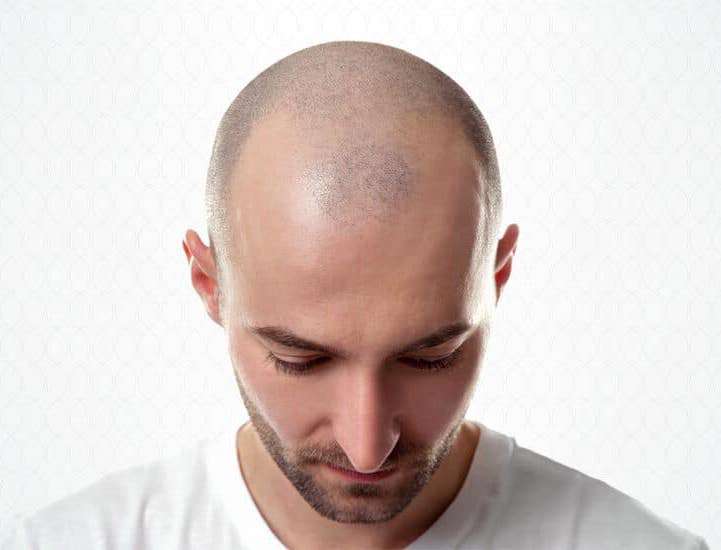 RevContent Ad Example 33217 - Hair Transplant Cost Might Actually Surprise You