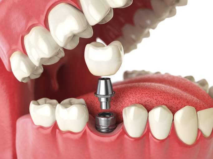 RevContent Ad Example 52103 - The Cost Of Dental Implants In Toronto Might Surprise You