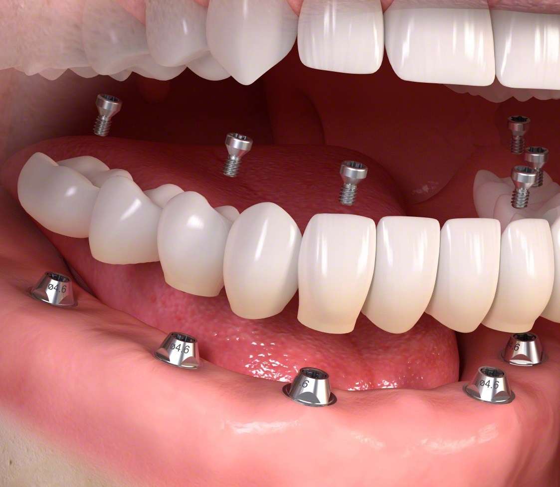 RevContent Ad Example 62210 - What Your New Dental Implants Should Cost You In Toronto