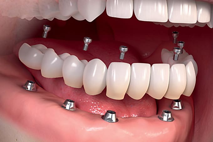 Taboola Ad Example 4232 - The Cost Of Dental Implants Might Surprise You
