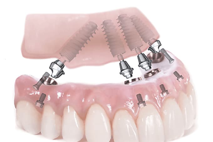 Taboola Ad Example 4242 - Dental Implants Should Cost This From Local Dentists