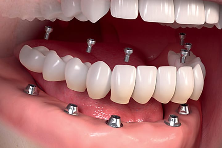 Taboola Ad Example 3709 - The Cost Of Dental Implants Might Surprise You
