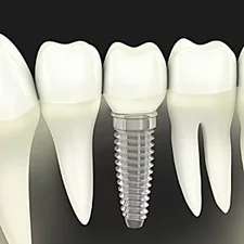 Outbrain Ad Example 40679 - Dental Implants Cost In 2019 May Surprise You