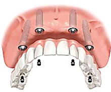 Taboola Ad Example 3348 - Dental Implants | Sponsored Links