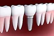 Outbrain Ad Example 33046 - Here's What New Dental Implants Should Cost In 2020