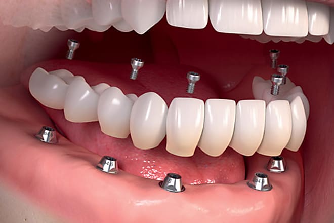Taboola Ad Example 6036 - Dental Implants Used To Be Expensive - Not Anymore