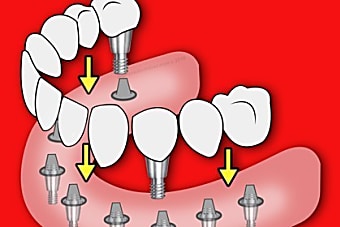 Taboola Ad Example 9517 - Dental Implants Used To Be Expensive - Not Anymore