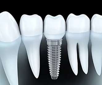 Outbrain Ad Example 33368 - Here's What New Dental Implants Should Cost In 2020