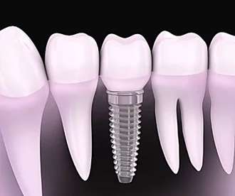 Outbrain Ad Example 33076 - Here's What New Dental Implants Should Cost In 2020