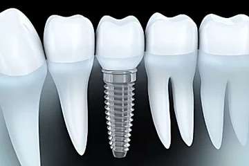 Outbrain Ad Example 40908 - Dental Implants Cost In 2019 May Surprise You