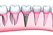 Outbrain Ad Example 33357 - Here's What New Dental Implants Should Cost In 2020