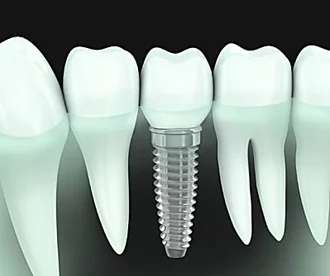 Outbrain Ad Example 31688 - Here's What New Dental Implants Should Cost In 2020