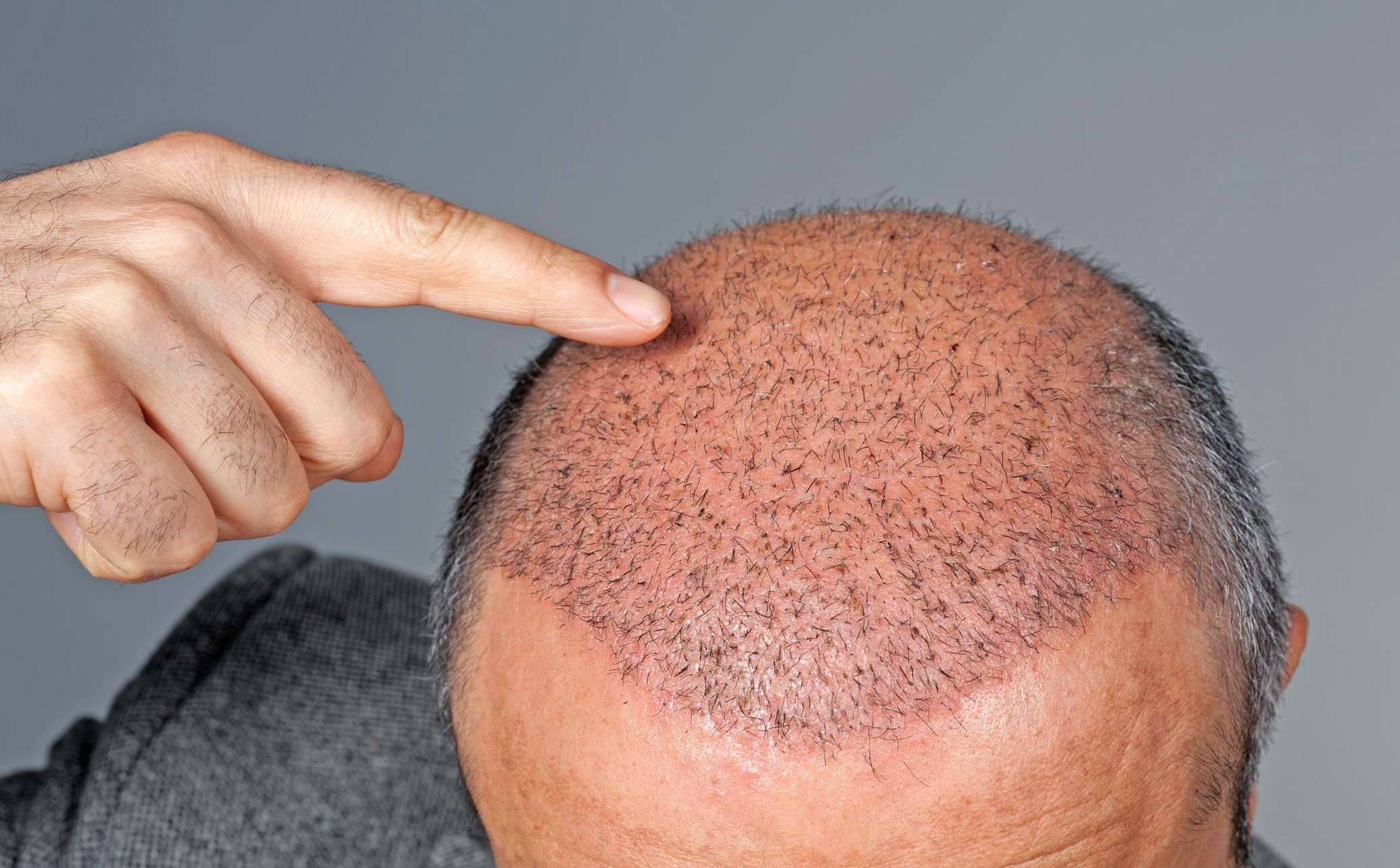 Taboola Ad Example 54490 - The Cost Of Hair Transplant In Turkey Might Surprise You