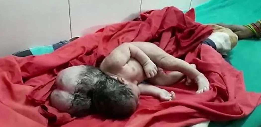 Outbrain Ad Example 41340 - Baby Baffles Doctors After Being Born With 'Three Heads'