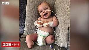 Outbrain Ad Example 56685 - Baby Loses All Four Limbs To Sepsis