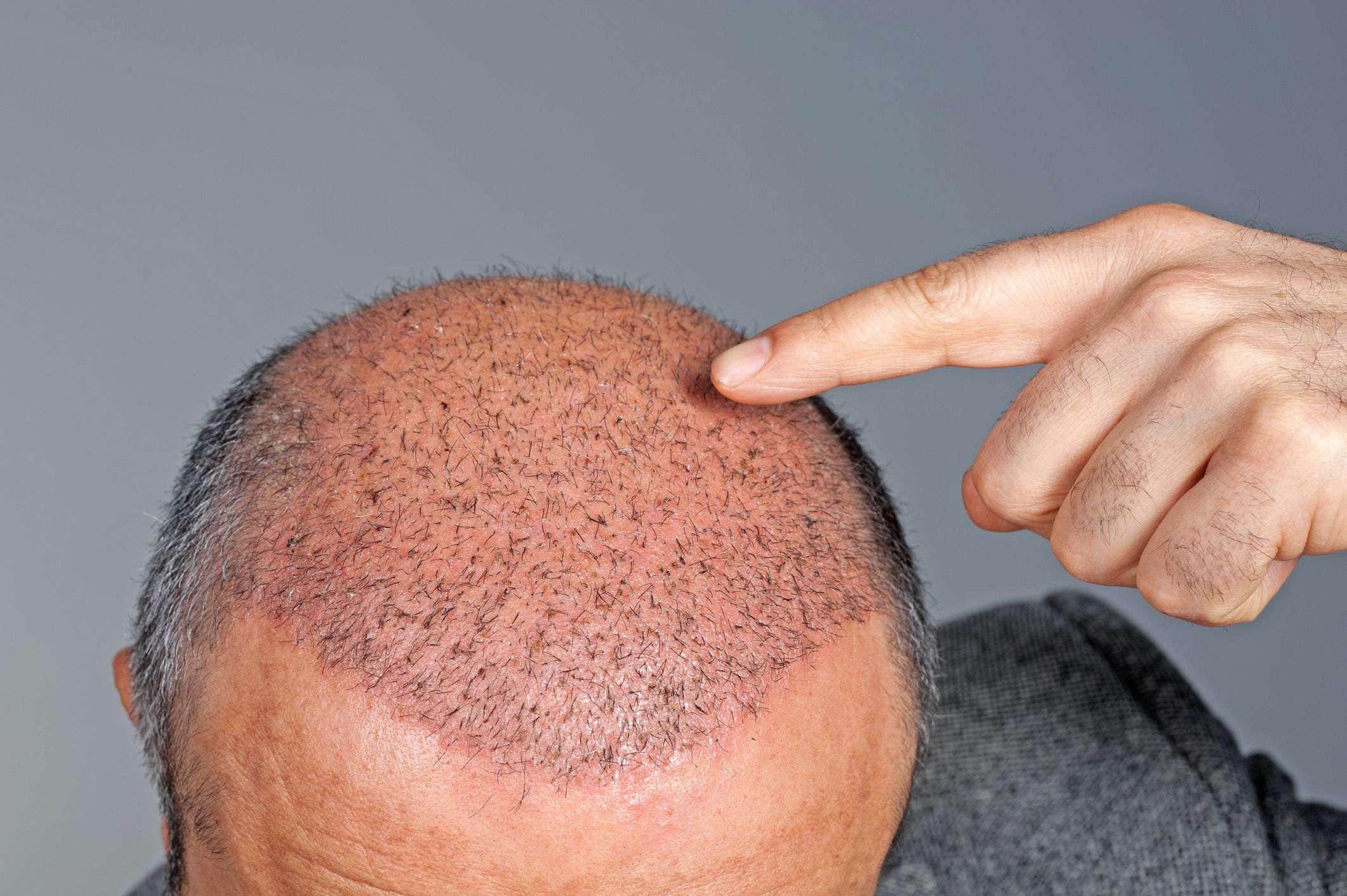 Taboola Ad Example 53040 - The Cost Of Hair Transplants In Toronto May Surprise You