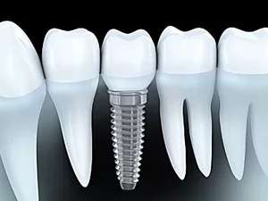 Outbrain Ad Example 42004 - Dental Implants Cost In 2019 May Surprise You