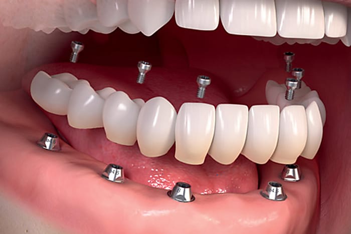 Taboola Ad Example 13568 - The True Price Of The Newest Dental Implants