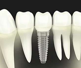 Outbrain Ad Example 31451 - Here's What New Dental Implants Should Cost In 2020
