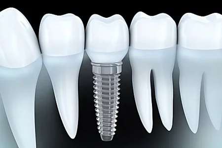 Outbrain Ad Example 43233 - Here Is What New Dental Implants Should Cost You In 2019