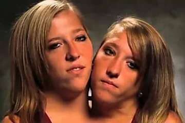 [Photos] Siamese Twins Are 27 Years Old - And Make a Life-Changing ...