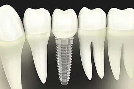 Outbrain Ad Example 58108 - Dental Implants Cost In 2019 May Surprise You