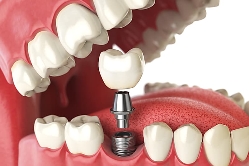 Taboola Ad Example 14633 - Dental Implants | Sponsored Links