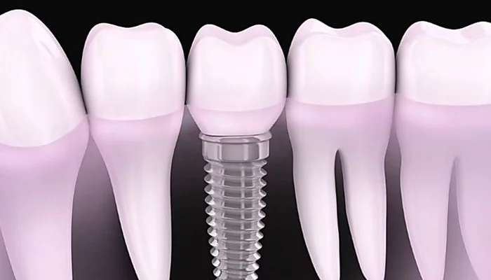Outbrain Ad Example 40474 - Dental Implants Cost In 2019 May Surprise You