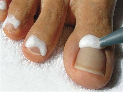 RevContent Ad Example 10588 - Do This To End Toenail Fungus (Try Today)