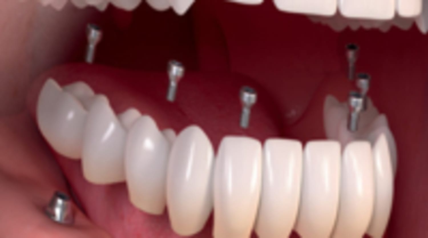 Taboola Ad Example 13457 - Dental Implants | Sponsored Listings