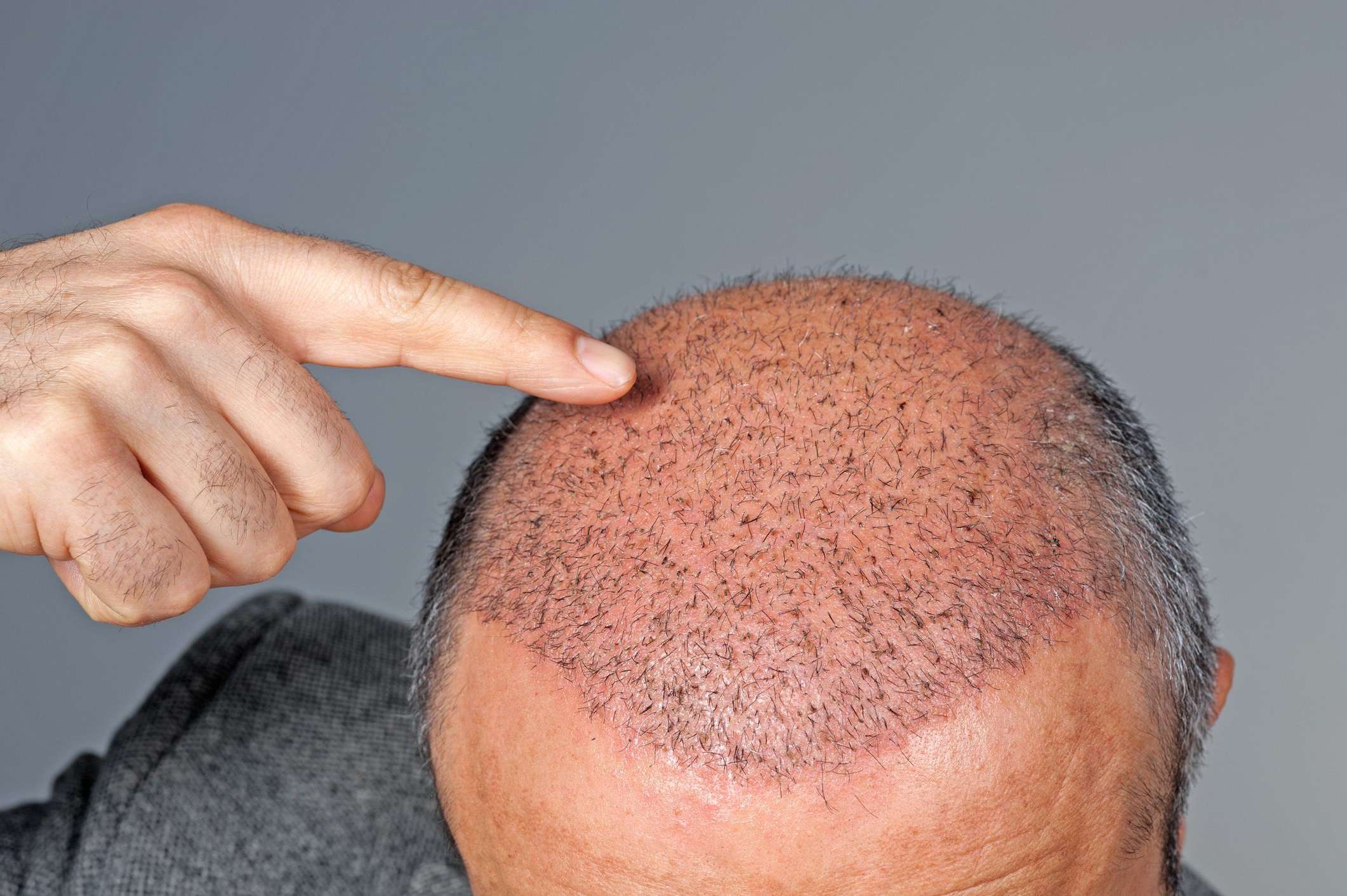 Taboola Ad Example 54493 - The Cost Of Hair Transplant In Turkey Might Surprise You