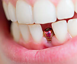Taboola Ad Example 12236 - Dental Implants | Sponsored Links