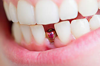 Taboola Ad Example 18979 - Dental Implants | Sponsored Links