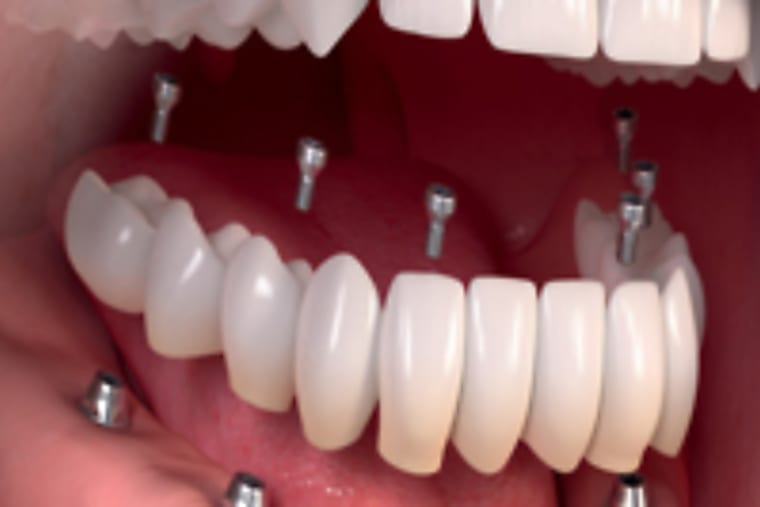Taboola Ad Example 13153 - Dental Implants | Sponsored Listings