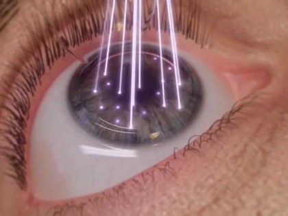 1 Odd Method "Restores" Your Eyes To Perfect Vision ...