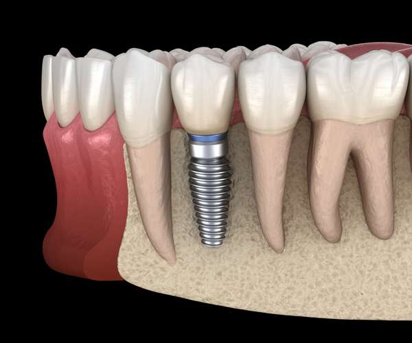 RevContent Ad Example 54763 - Permanently Repair Your Smile - Dental Implants At A Price That May Surprise You